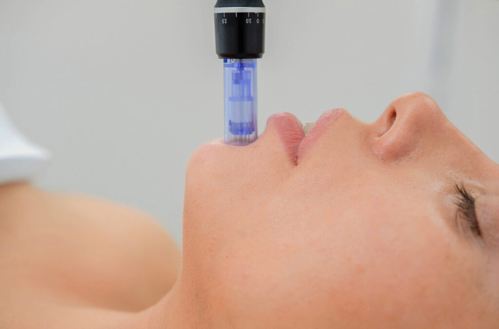 Microneedling in Bremen